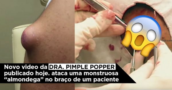 Doutora Pimple Popper ataca um verdadeiro MONSTRO